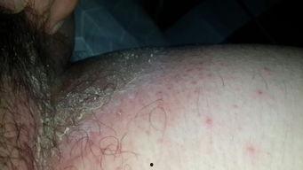 梅毒明星,揭秘梅毒传播背后的真相与警示